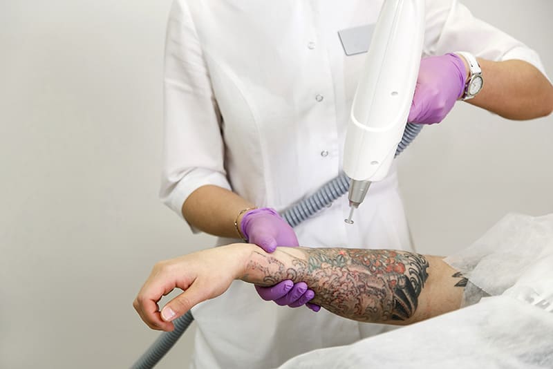 NiSV Akademie:Kann ein dauerhaftes Tattoo entfernt werden?